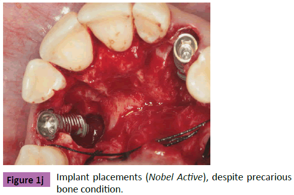 periodontics-prosthodontics-Implant-placements-precarious