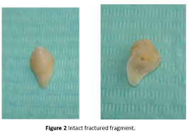 periodontics-prosthodontics-Intact-fractured-fragment