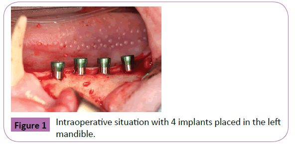 periodontics-prosthodontics-Intraoperative-situation
