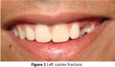 periodontics-prosthodontics-Left-canine-fracture