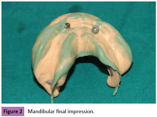 periodontics-prosthodontics-Mandibular-final-impression