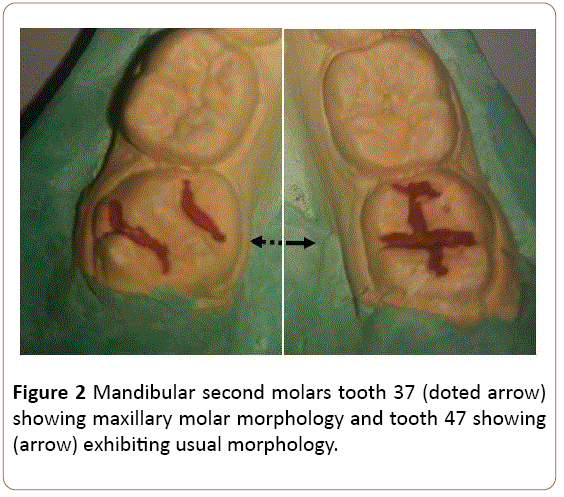 periodontics-prosthodontics-Mandibular-second