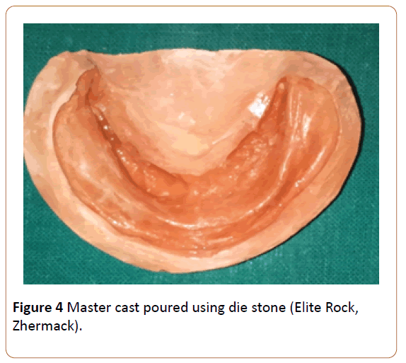 periodontics-prosthodontics-Master-cast