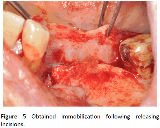 periodontics-prosthodontics-Obtained-immobilization