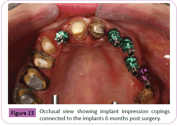 periodontics-prosthodontics-Occlusal-showing-implant