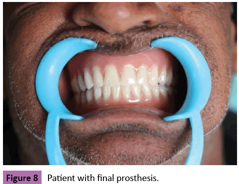 periodontics-prosthodontics-Patient-final-prosthesis