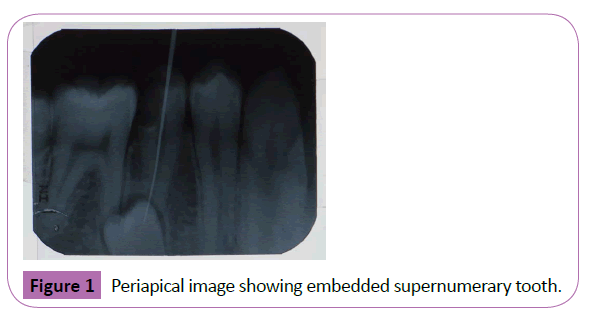 periodontics-prosthodontics-Periapical-image