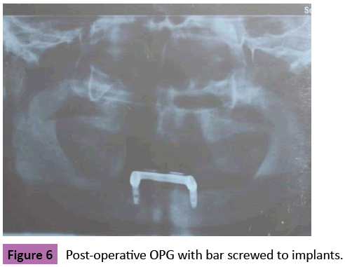 periodontics-prosthodontics-Post-operative-screwed