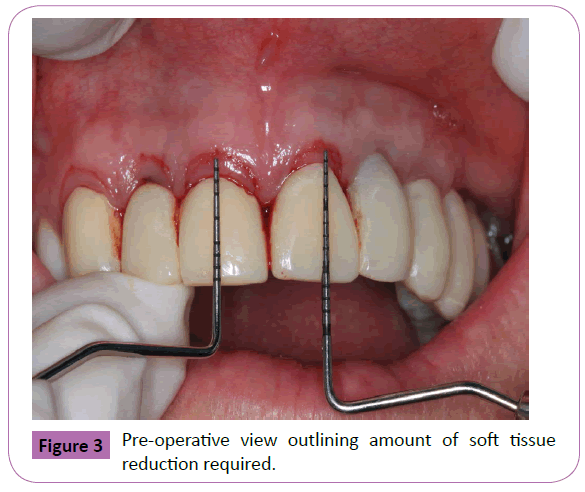 periodontics-prosthodontics-Pre-operative-outlining