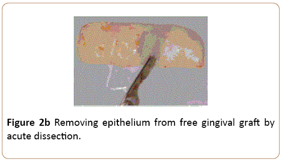 periodontics-prosthodontics-Removing-epithelium