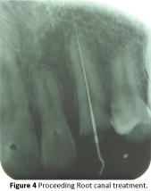 periodontics-prosthodontics-Root-canal-treatment