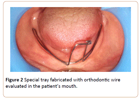 periodontics-prosthodontics-Special-tray