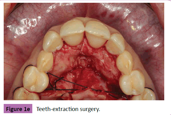 periodontics-prosthodontics-Teeth
