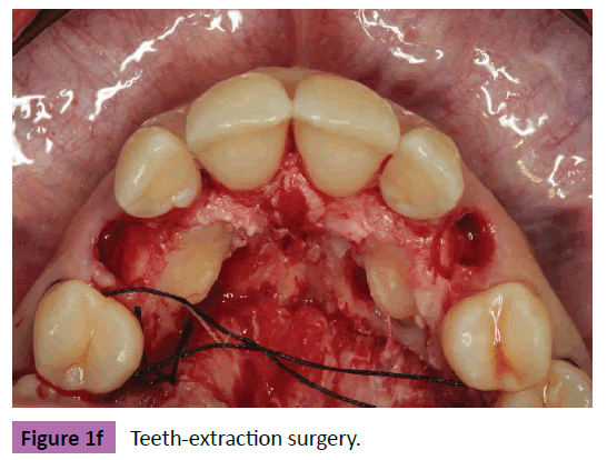 periodontics-prosthodontics-Teeth-extraction