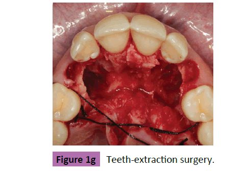 periodontics-prosthodontics-Teeth-extraction-surgery