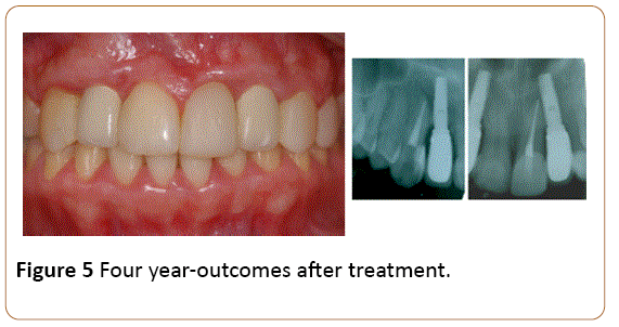 periodontics-prosthodontics-after-treatment