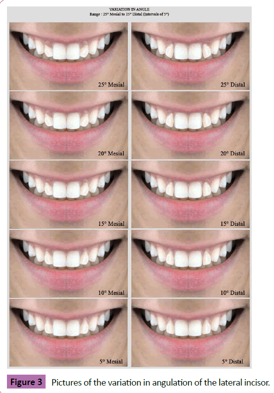 periodontics-prosthodontics-angulation-lateral-incisor