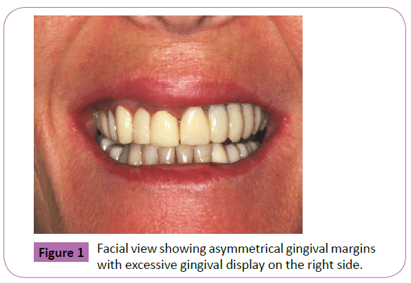 periodontics-prosthodontics-asymmetrical-gingival-margins