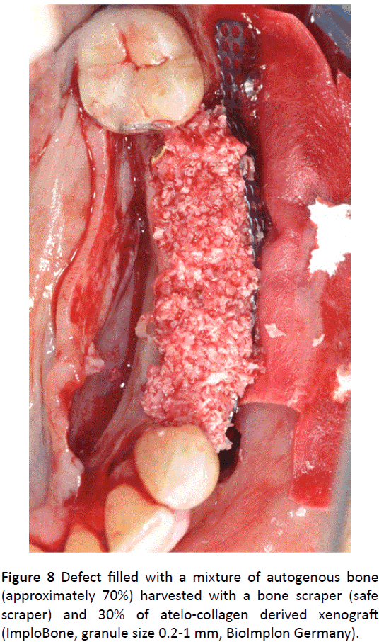 periodontics-prosthodontics-autogenous-bone