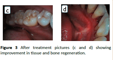 periodontics-prosthodontics-bone