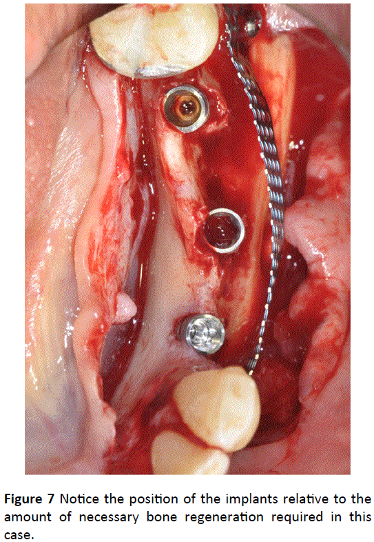 periodontics-prosthodontics-bone-regeneration