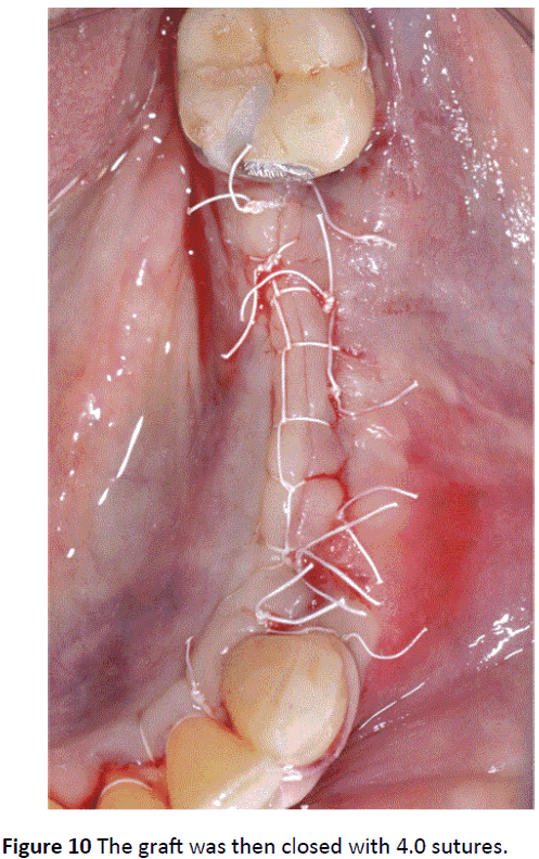 periodontics-prosthodontics-closed-sutures
