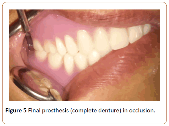 periodontics-prosthodontics-complete-denture