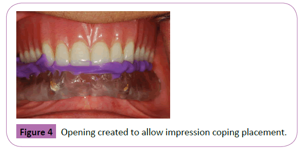 periodontics-prosthodontics-coping-placement