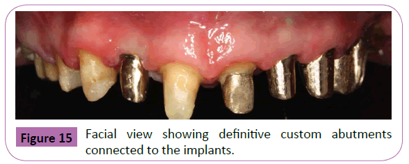 periodontics-prosthodontics-definitive-custom-abutments