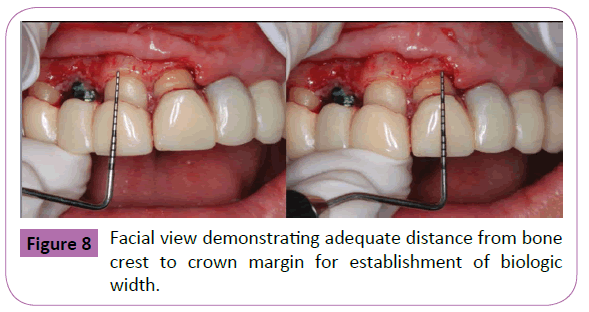 periodontics-prosthodontics-demonstrating-adequate-distance