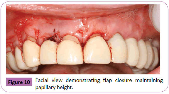 periodontics-prosthodontics-demonstrating-flap-closure