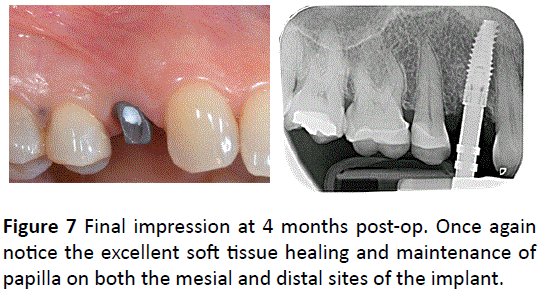 periodontics-prosthodontics-distal-sites