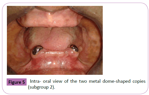 periodontics-prosthodontics-dome-shaped
