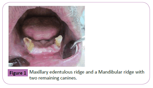 periodontics-prosthodontics-edentulous-ridge