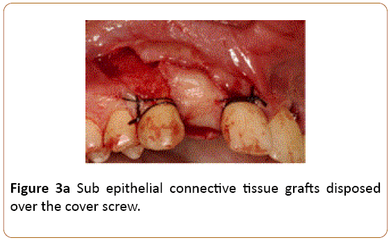 periodontics-prosthodontics-epithelial-connective