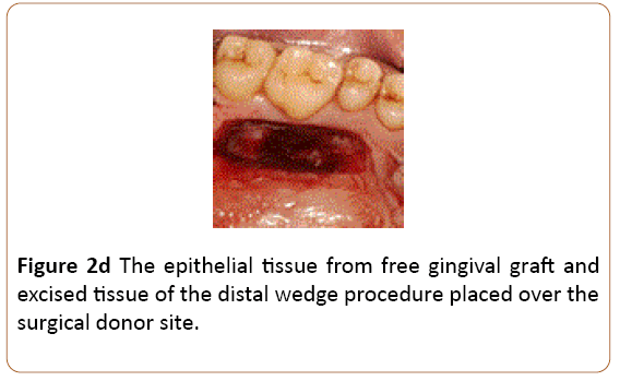 periodontics-prosthodontics-epithelial-tissue