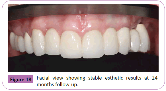 periodontics-prosthodontics-esthetic-results-24-months