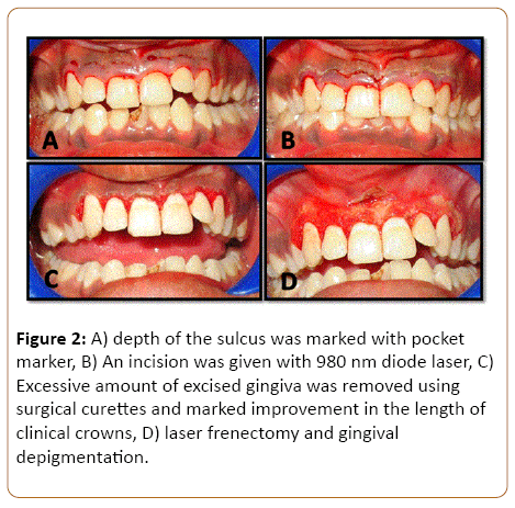 periodontics-prosthodontics-excised-gingiva