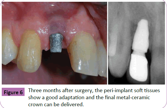 periodontics-prosthodontics-final-metal-ceramic-crown