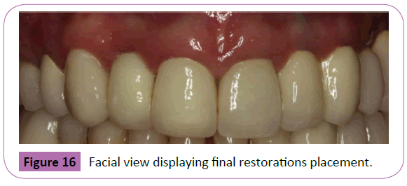 periodontics-prosthodontics-final-restorations-placement