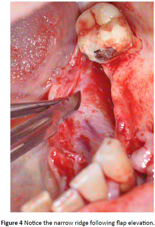 periodontics-prosthodontics-flap-elevation