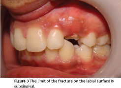 periodontics-prosthodontics-fracture-labial-subgingival