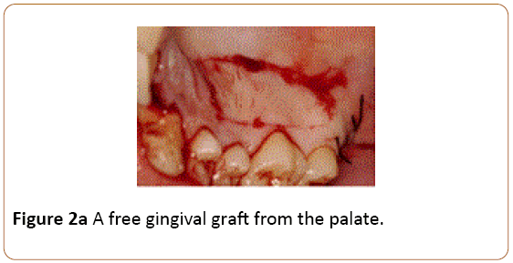 periodontics-prosthodontics-gingival-graft