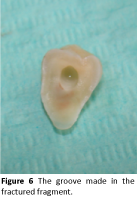 periodontics-prosthodontics-groove-fractured-fragment
