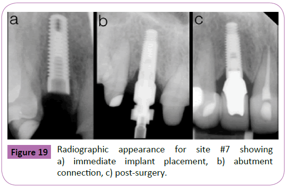 periodontics-prosthodontics-immediate-implant-placement