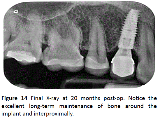 periodontics-prosthodontics-implant-interproximally