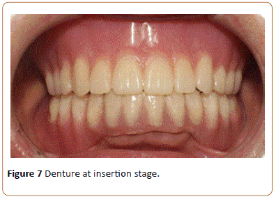 periodontics-prosthodontics-insertion