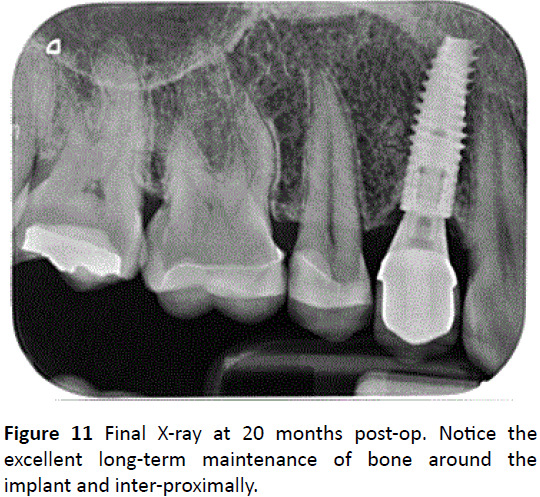 periodontics-prosthodontics-inter-proximally