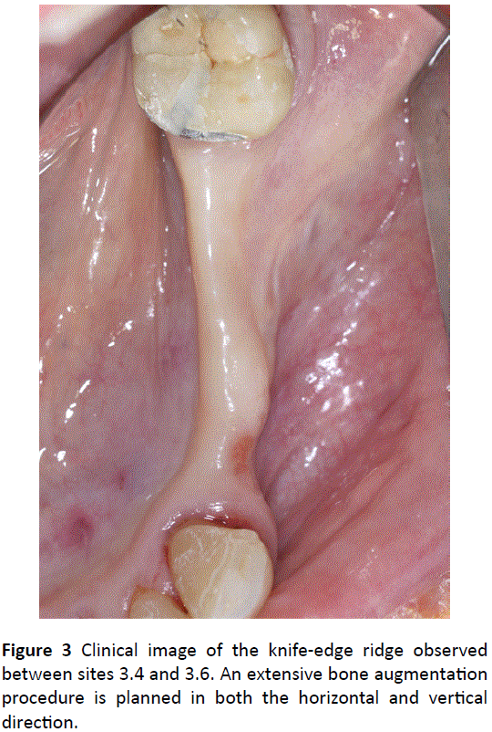 periodontics-prosthodontics-knife-edge