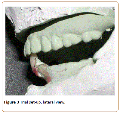 periodontics-prosthodontics-lateral-view